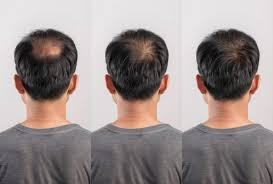 Why Hair Loss Happens in Men and the Treatments That Can Help